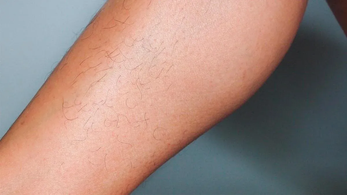 Laser hair removal, before treatment