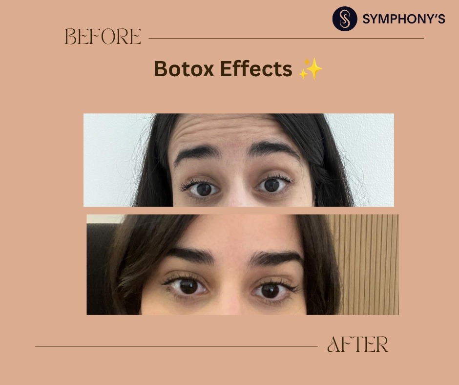 Botox before and after at Symphony Clinic Dubai: forehead and frown lines softened