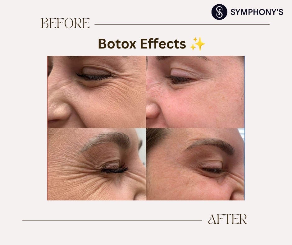 Botox before and after at Symphony Clinic Dubai: crow’s feet at rest and smiling