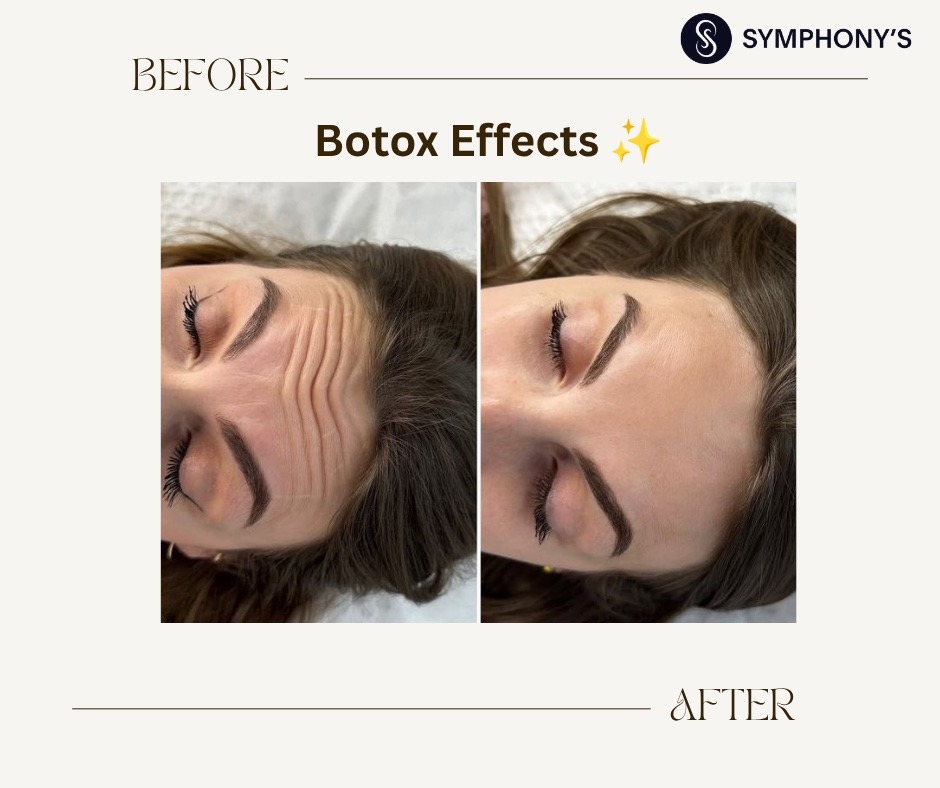 Botox before and after at Symphony Clinic Dubai: crow’s feet when squinting