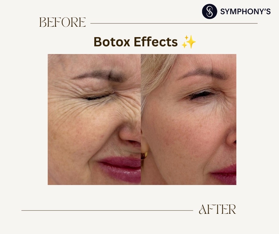Botox before and after at Symphony Clinic Dubai: crow’s feet softened, smile intact