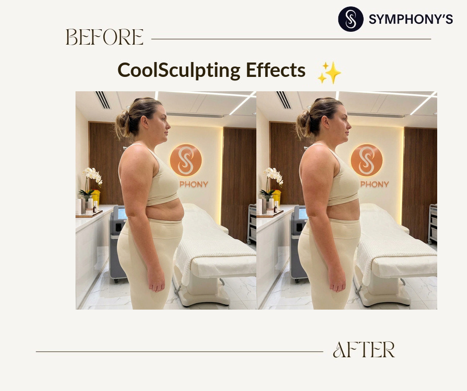 CoolSculpting before and after at Symphony Clinic Dubai: lower belly flattened