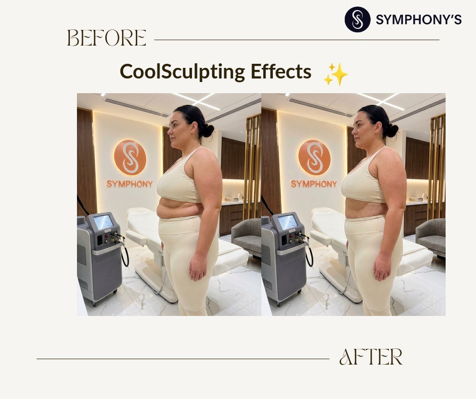 CoolSculpting before and after at Symphony Clinic Dubai: upper stomach smoothed