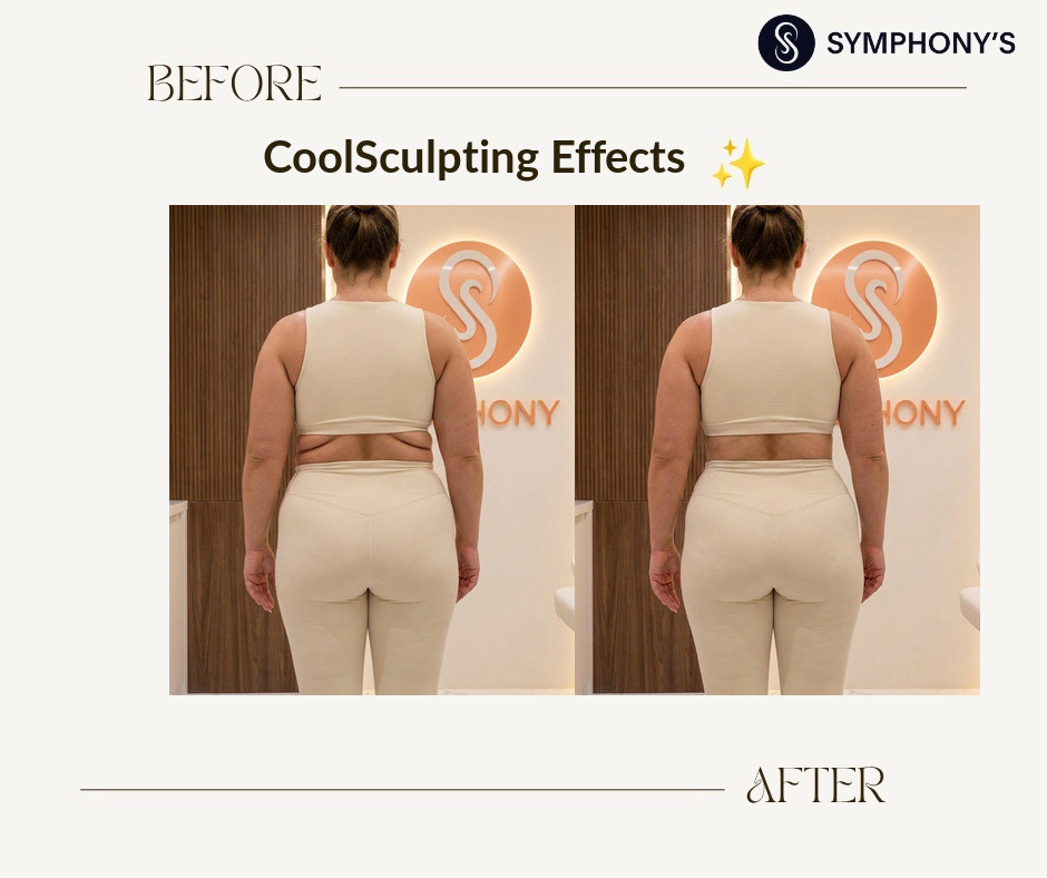 CoolSculpting before and after at Symphony Clinic Dubai: love handles cleared
