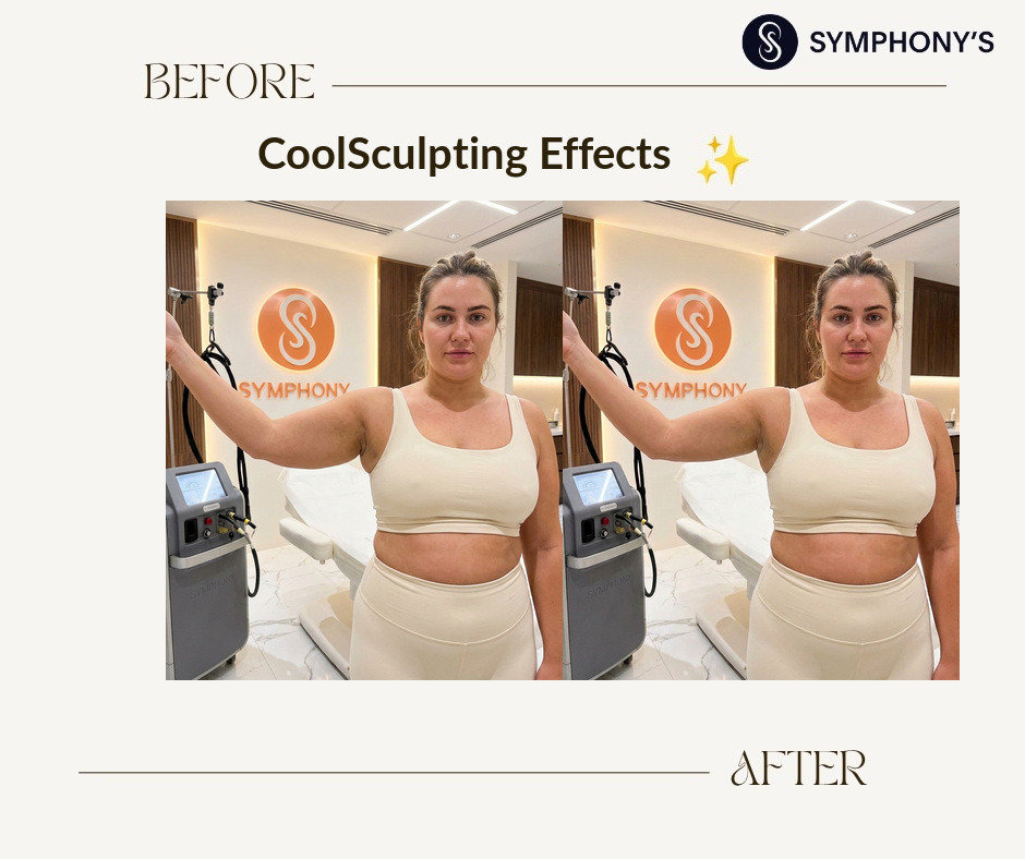 CoolSculpting before and after at Symphony Clinic Dubai: arms slimmed
