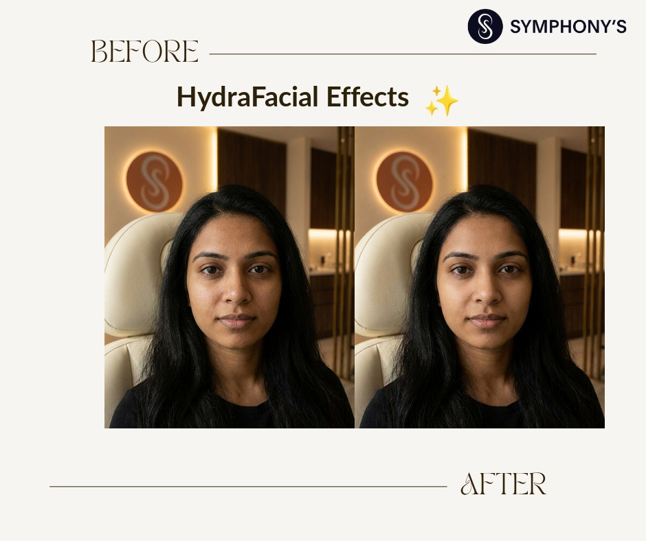 HydraFacial before and after at Symphony Clinic Dubai: congested pores cleared