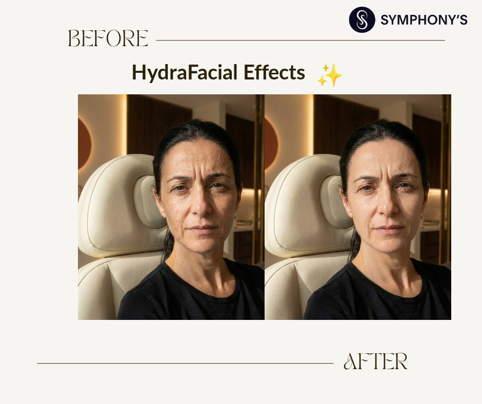 HydraFacial before and after at Symphony Clinic Dubai: breakout-prone skin calmed