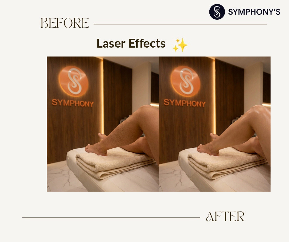 Laser hair removal before and after at Symphony Clinic Dubai: legs