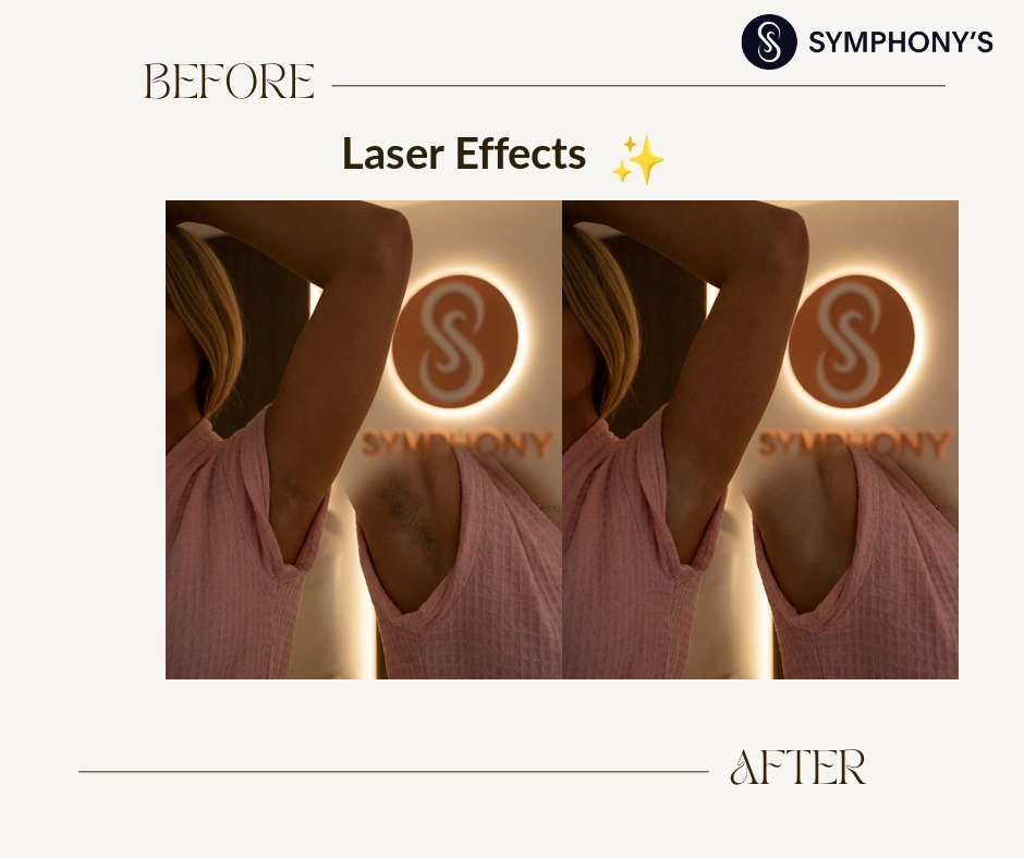 Laser hair removal before and after at Symphony Clinic Dubai: underarms