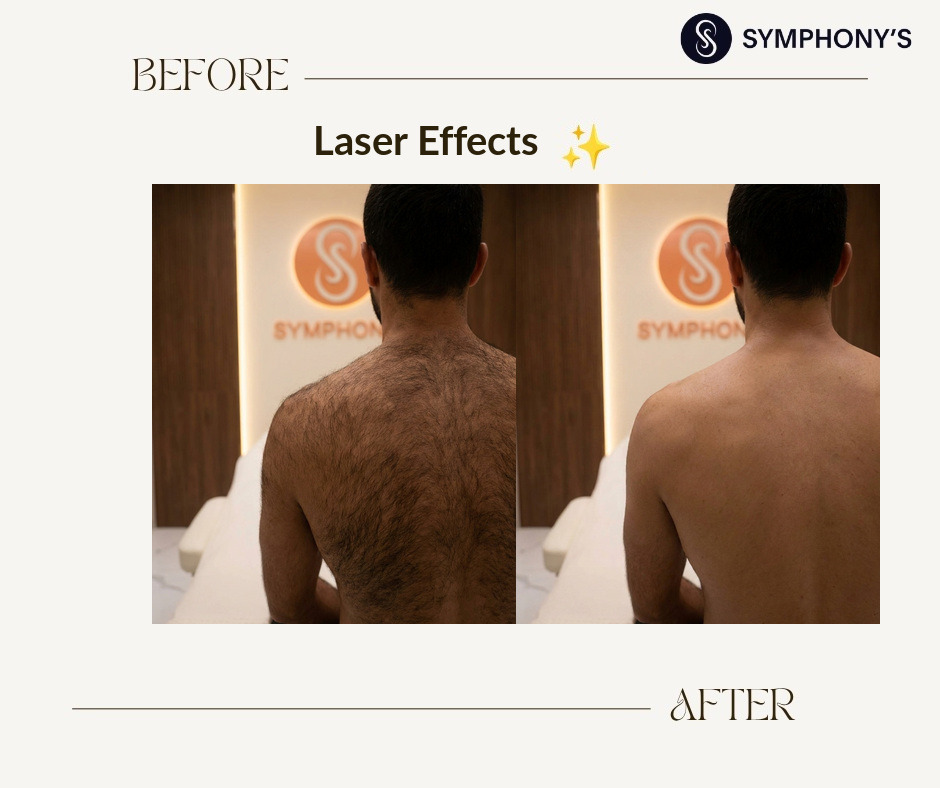 Laser hair removal before and after at Symphony Clinic Dubai: back