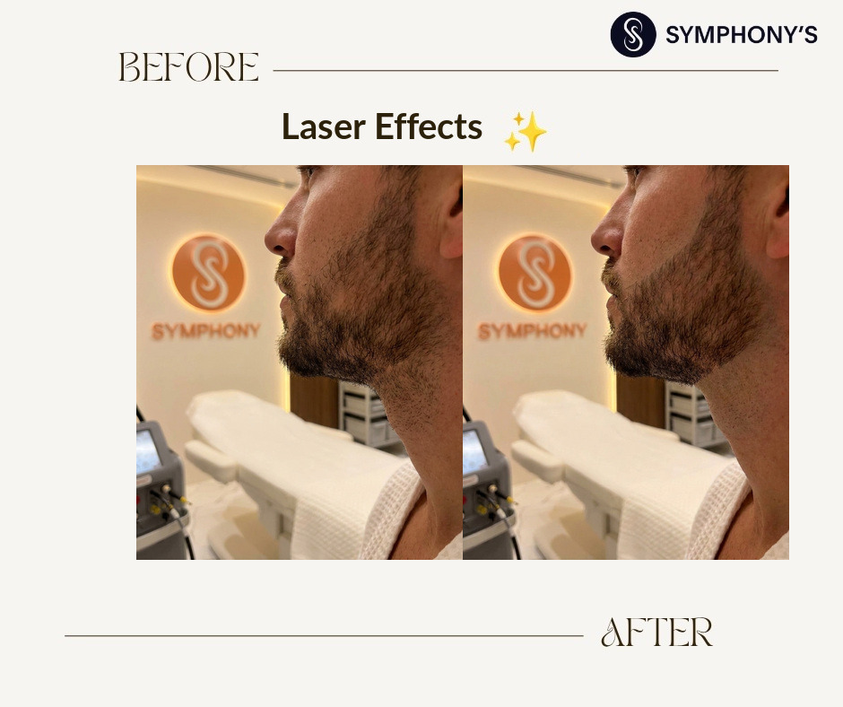 Laser hair removal before and after at Symphony Clinic Dubai: beard line
