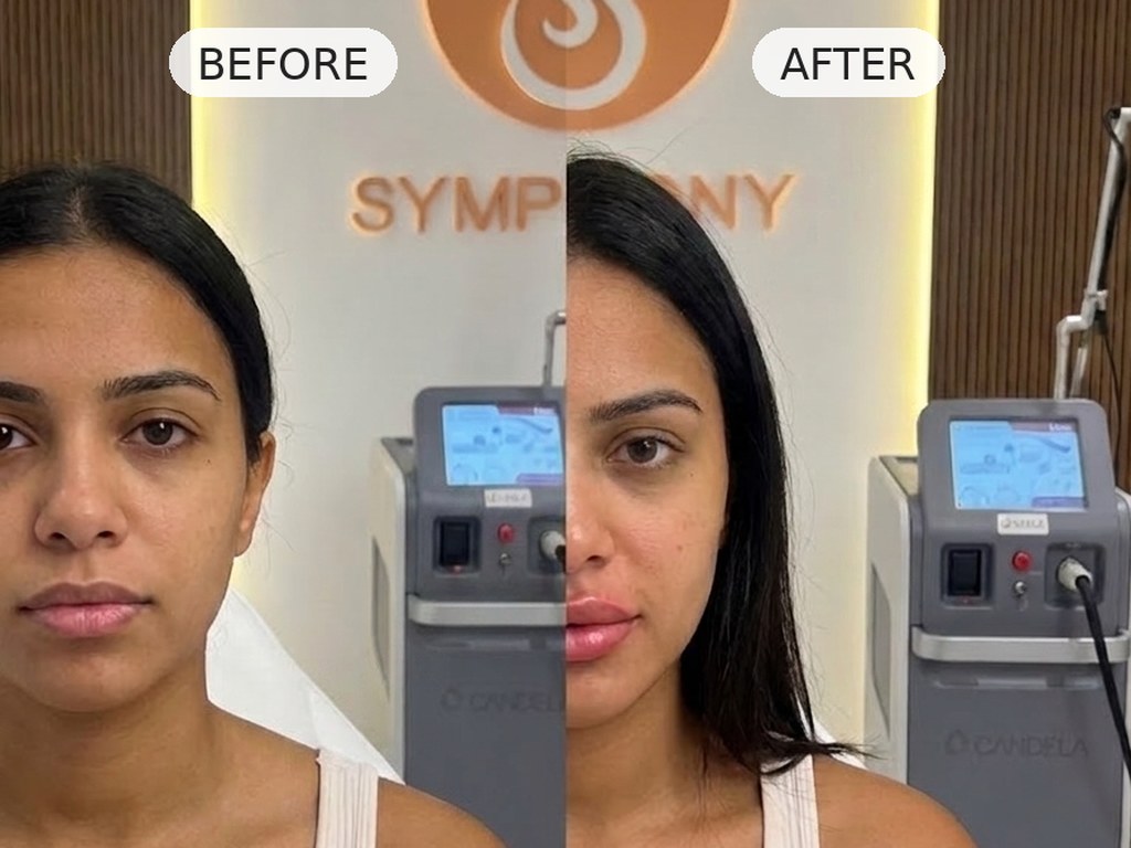 Lip filler before and after at Symphony Clinic Dubai: balanced, symmetric lips