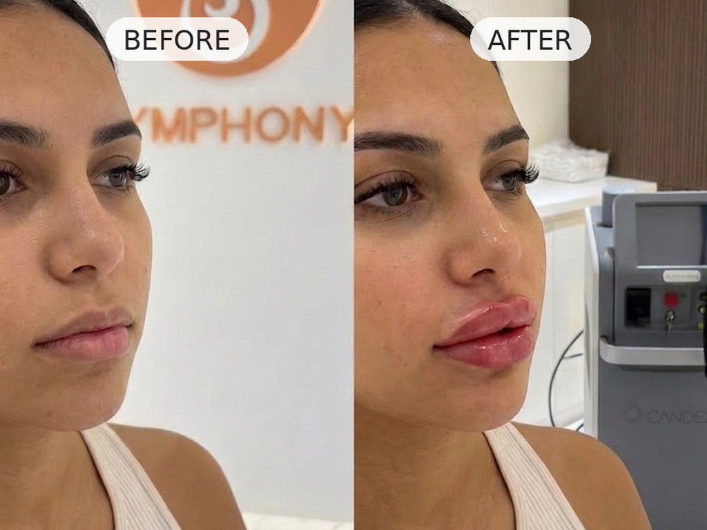 Lip filler before and after at Symphony Clinic Dubai: defined profile, natural projection