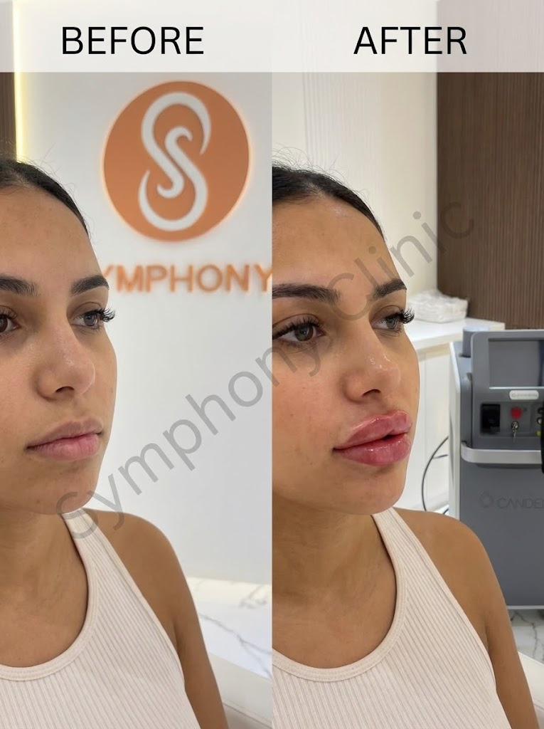 Lip Filler Before and After - Natural volume enhancement at Symphony Clinic Dubai
