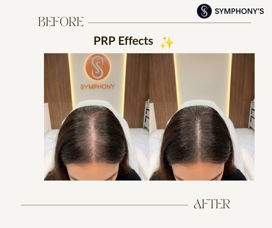 PRP before and after at Symphony Clinic Dubai: parting filled in