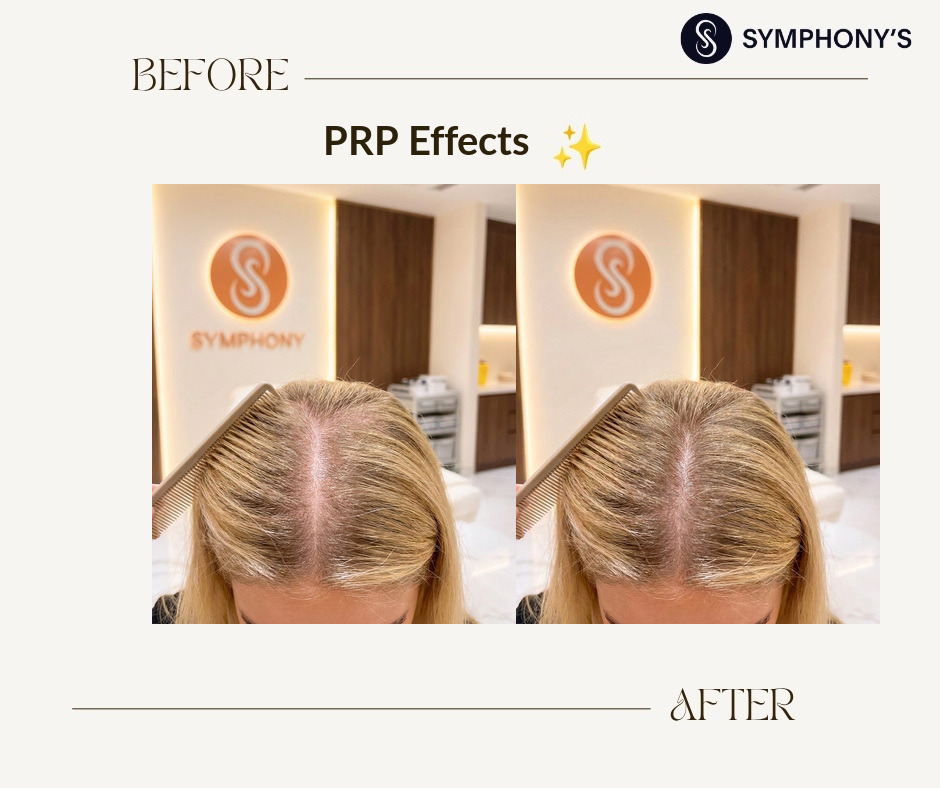 PRP before and after at Symphony Clinic Dubai: crown density restored