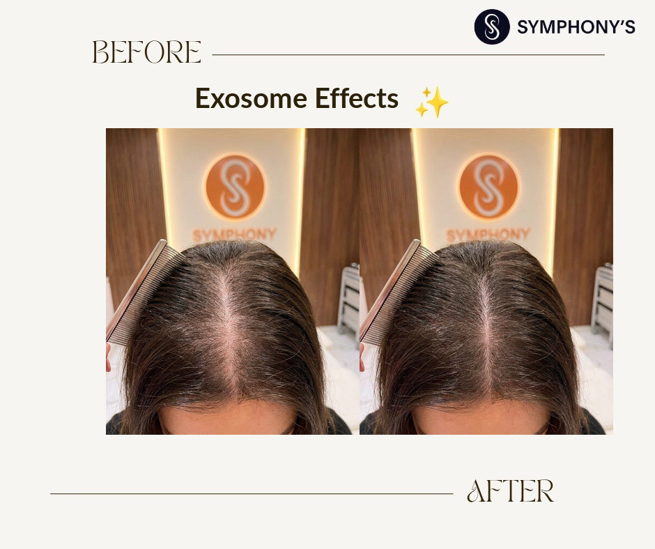 Exosome before and after: parting filled in