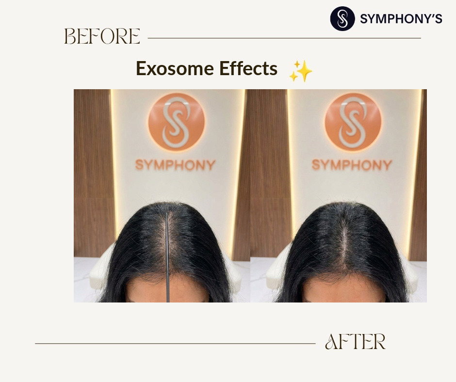 Exosome before and after: hair thicker along the parting