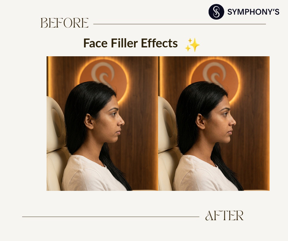 Face filler before and after at Symphony Clinic Dubai: chin projection balanced