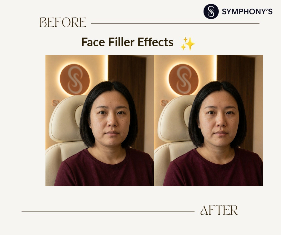 Face filler before and after at Symphony Clinic Dubai: proportions balanced
