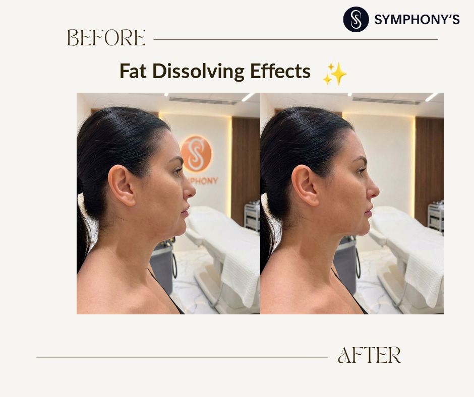 Fat dissolving before and after at Symphony Clinic Dubai: double chin cleared