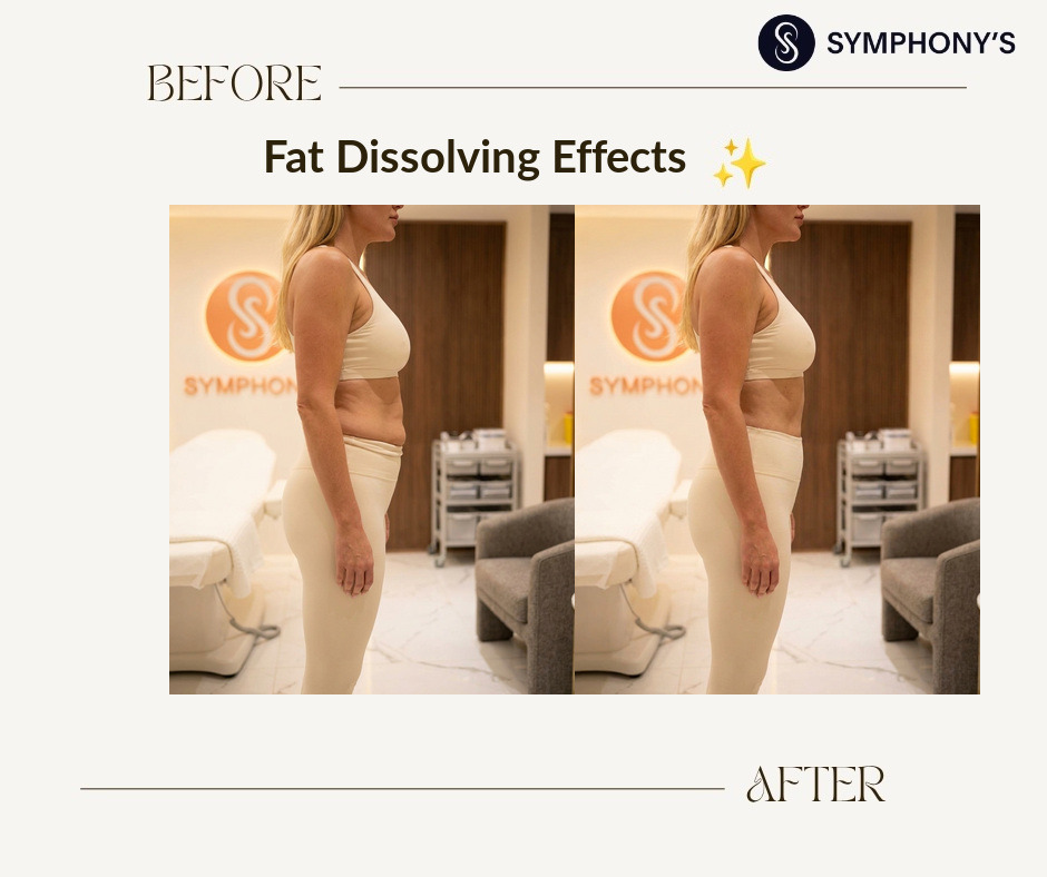 Fat dissolving before and after at Symphony Clinic Dubai: lower belly flattened