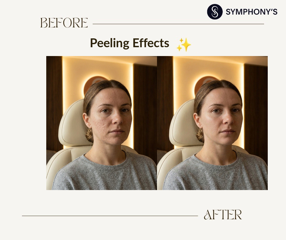 Chemical peel before and after at Symphony Clinic Dubai: scarring improved