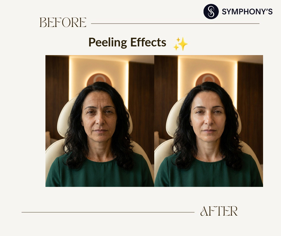 Chemical peel before and after at Symphony Clinic Dubai: texture refined