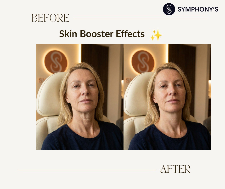 Skin booster before and after: neck lines smoothed