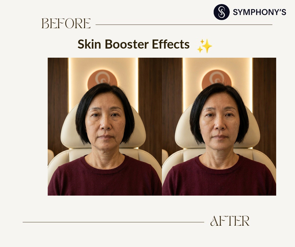 Skin booster before and after: firmness restored