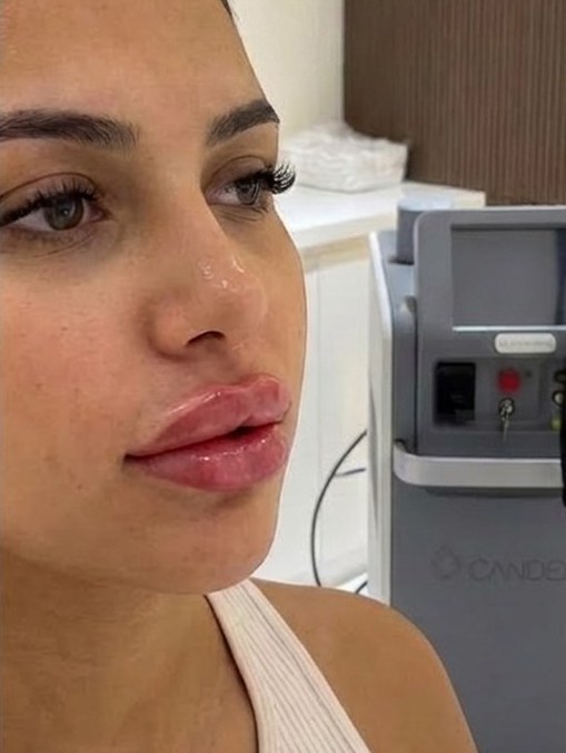 Lips after 1 ml filler, real Symphony Clinic patient