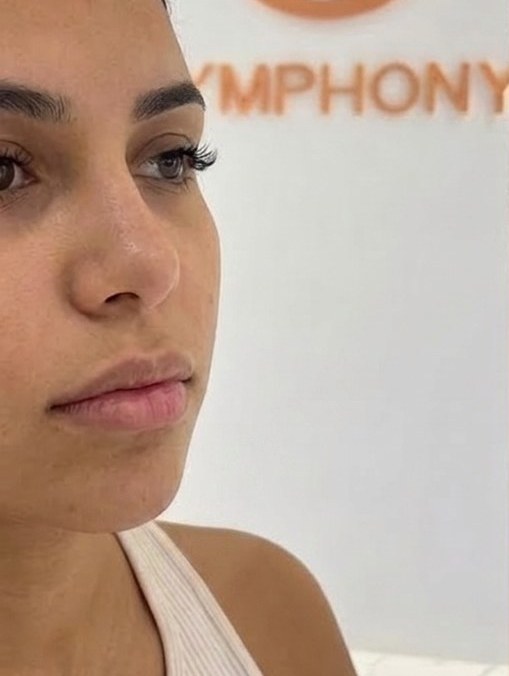 Lips before filler, real Symphony Clinic patient