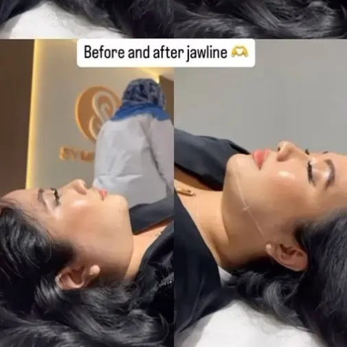 Symphony Clinic Dubai Instagram reel - Face Fillers