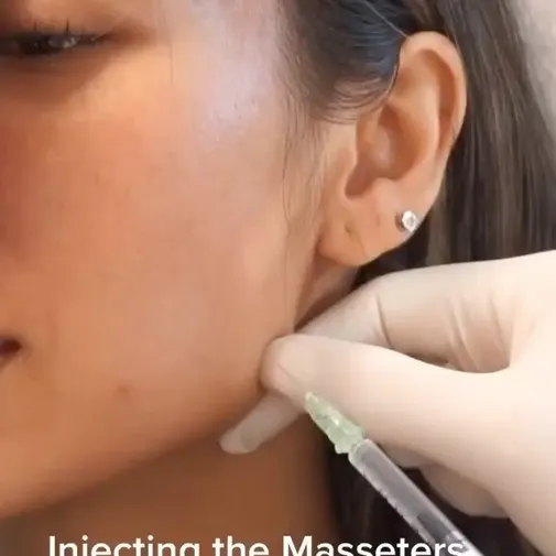 Symphony Clinic Dubai Instagram reel - Botox
