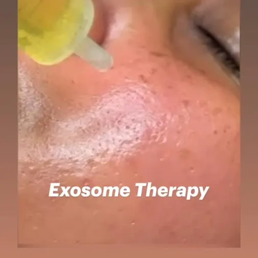 Symphony Clinic Dubai Instagram reel - Skin Boosters