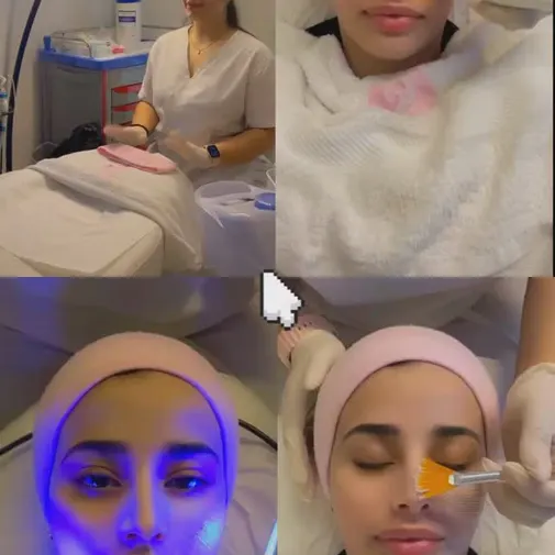 Symphony Clinic Dubai Instagram reel - Microneedling