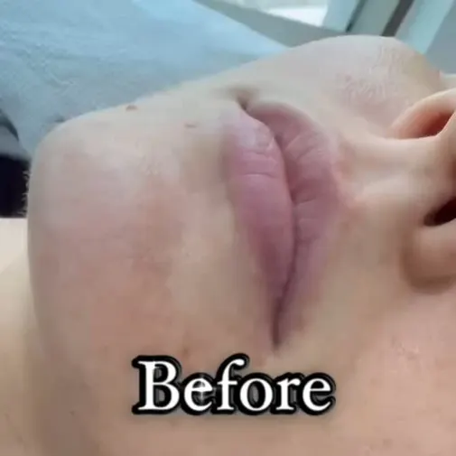 Symphony Clinic Dubai Instagram reel - Lip Fillers