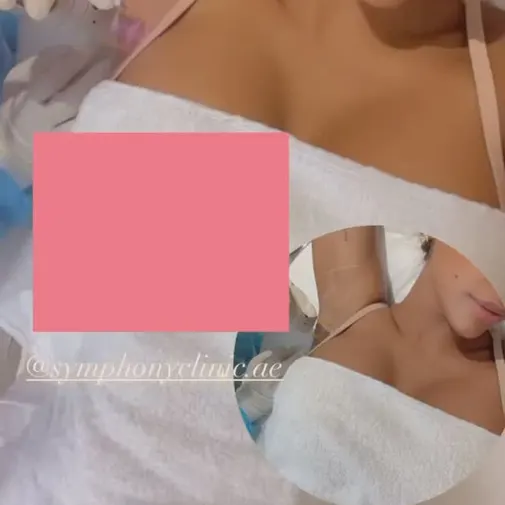 Symphony Clinic Dubai Instagram reel - Laser Hair Removal