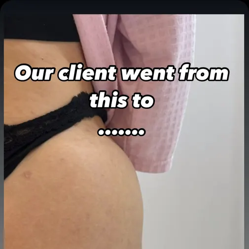 Symphony Clinic Dubai Instagram reel - Butt Filler