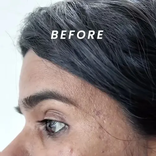 Symphony Clinic Dubai Instagram reel - Peeling