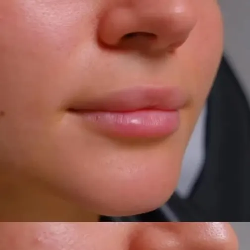 Symphony Clinic Dubai Instagram reel - Lip Fillers