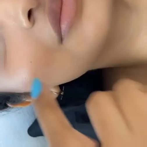 Symphony Clinic Dubai Instagram reel - Lip Fillers