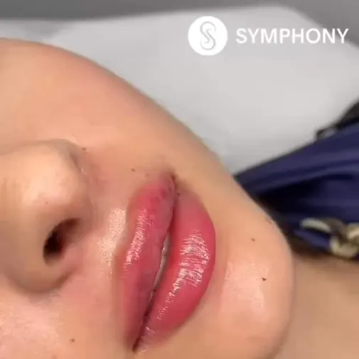 Symphony Clinic Dubai Instagram reel - Lip Fillers