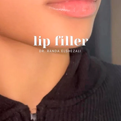 Symphony Clinic Dubai Instagram - Botox reel