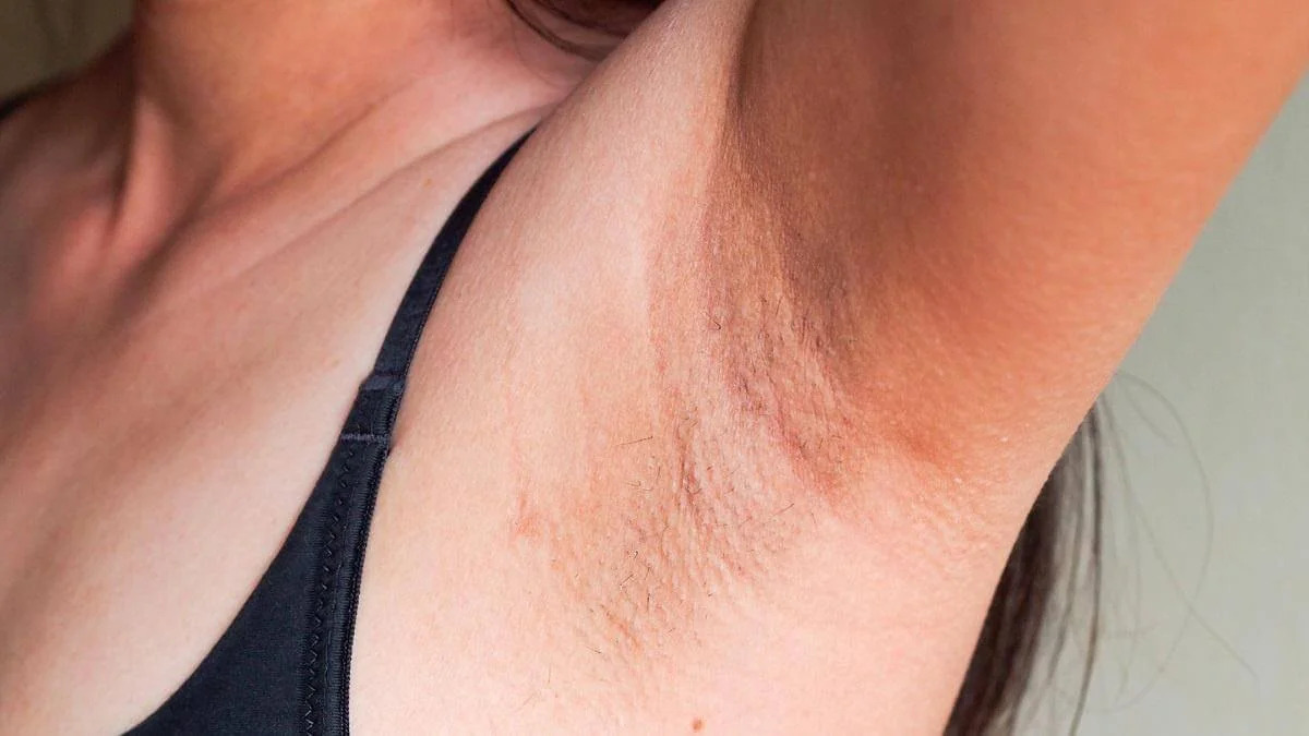 Before full body laser hair removal